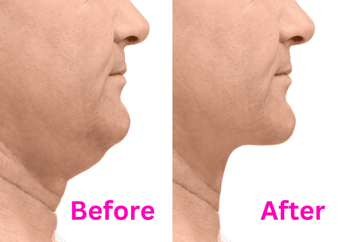Chin liposuction by laser Before After