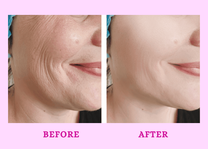 Facial Fine Lines and Wrinkles
