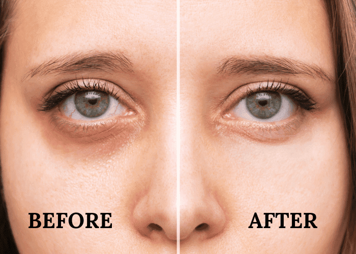 Under eye pigmentation